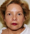 Feel Beautiful - Browlift San Diego Case 12 - After Photo